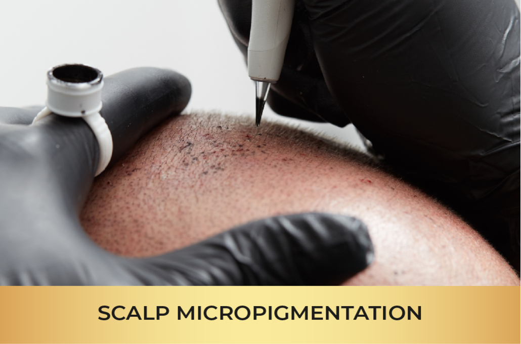 scalp micropigmentation atlanta hair loss
